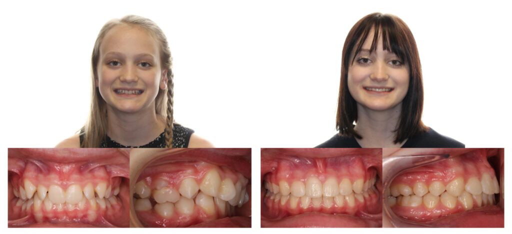 Before & Afters | Rise + Smile Orthodontics | Austin Orthodontics