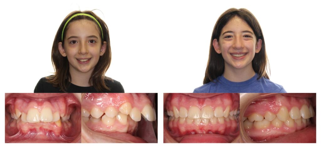 Before & Afters | Rise + Smile Orthodontics | Austin Orthodontics