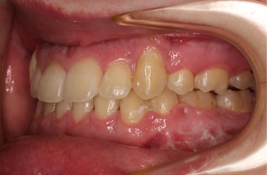 Can Braces Fix an Underbite?